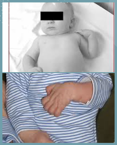 <p>what neurological injury is this picture demonstrating? </p>