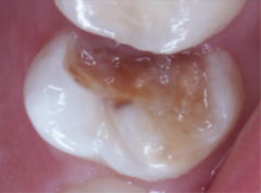 <p>What ICDAS score would be given to this tooth?</p>