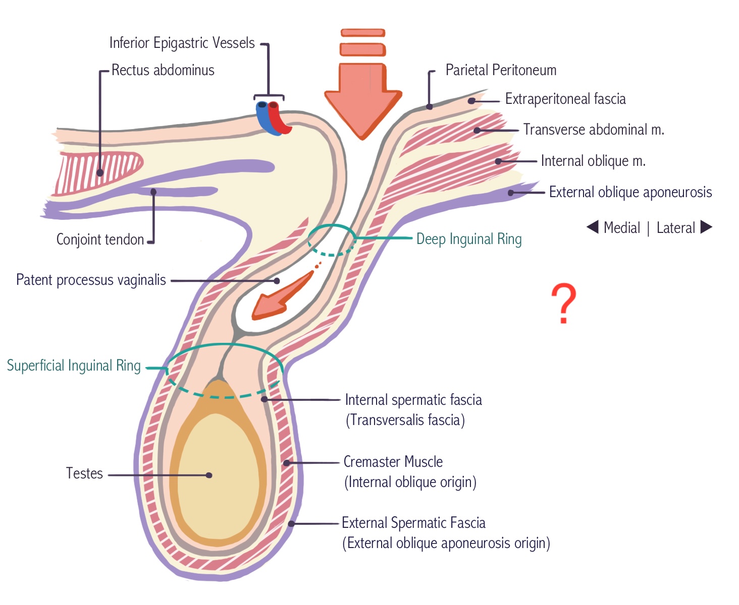 <p>What hernia lies lateral to the inferior epigastric vessels and is congenital and associated with the persistence of the processus vaginalis if not sealed correctly?</p>