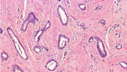 <p>How would you grade this infiltrative ductal carcinoma?</p>