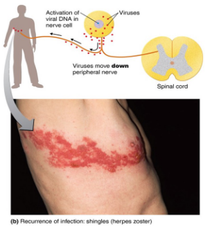 <p><span style="font-size: calc(var(--scale-factor)*12.00px);">Reactivation of the latent varicella-zoster virus that moves from dorsal root ganglia along peripheral nerves to the skin ; due to high stress of lowered immunity</span></p>