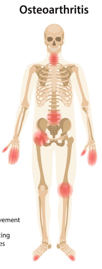 <p>low grade inflammation in 4 or fewer joints</p>