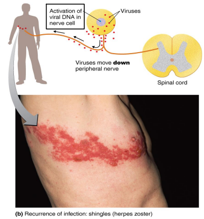 <ul><li><p><strong>Pathogen → HHV-3</strong></p></li><li><p>Reactivation of the latent varicella-zoster virus (chickpox) that moves along peripheral nerves to the skin</p><ul><li><p>Due to stress or lowered immunity</p></li></ul></li><li><p>Follows the distribution of affected cutaneous sensory nerves</p><ul><li><p>Limited to one side of the body</p></li></ul></li><li><p>Postherpetic neuralgia</p></li><li><p>Prevention via the zoster vaccine</p></li><li><p>Antiviral drugs may lessen symptoms.</p></li></ul><p></p>