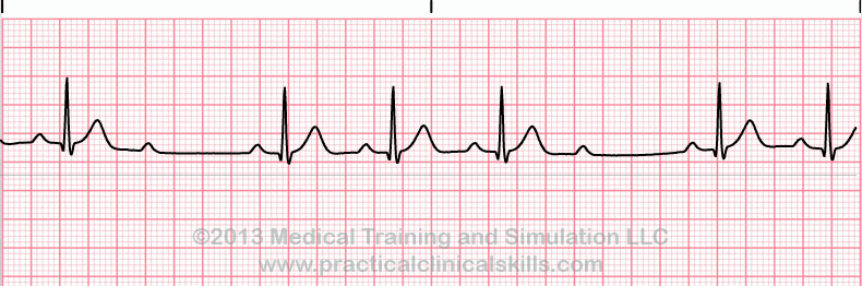 <p>Rate: depends on underlying rhythm</p><p>Regularity: irregularly irregular </p><p>If some P’s don’t get through </p>