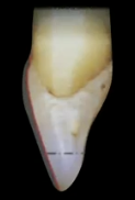 <p>What kind of incisal reduction is this</p>
