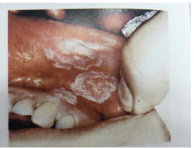 <p>BN CÓ VẾT LOÉT, CẢM GIÁC NÓNG , NGỨA, NIÊM MẠC PHÙ NỀ, SƯNG ĐỎ , BỀ MẶT CĂNG BÓNG </p><p>CHẨN ĐOÁN?</p>