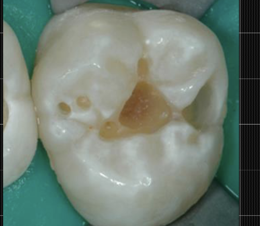 <p>Firm Dentin</p>