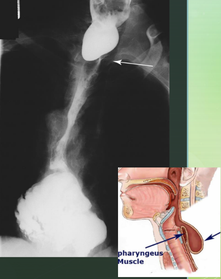 <p>Large outpouching of the esophagus just above the upper esophageal sphincter, potentially caused by weaking of the muscle wall.</p>