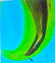 <p>due to rapid increases in file size and accumulation of dentinal debris in the apical 1/3 of the canal</p><p>malpositioned instrument stops</p>