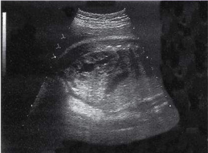 <p>consistent recognitiion of fetal kidneys begins during 20th week; homogeneous moderate to low in echogenicity cortex; common to visualize urine-filled, intrarenal collecting structures</p>