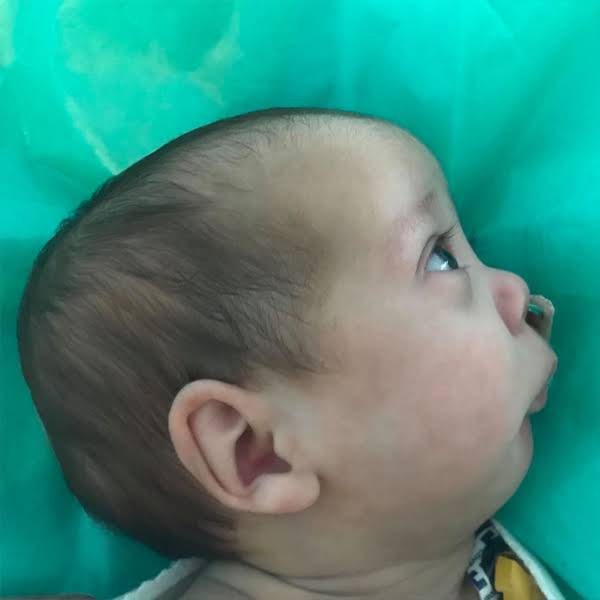 <p>small or retracted mandible (overbite)</p>