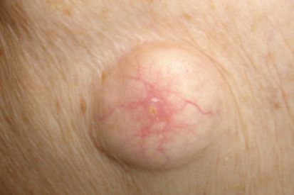 <p>encapsulated, fluid filled</p>