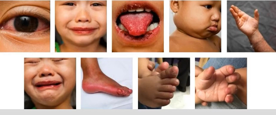 <p>what assessment findings suggest kawasaki disease?</p>