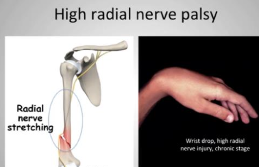 <p>Wrist drop with extensor atrophy and the hand hanging in flexion</p>