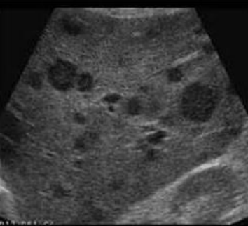 <p>pt presents with enlarged lymph nodes and night sweats, what is the dz and sonography</p>