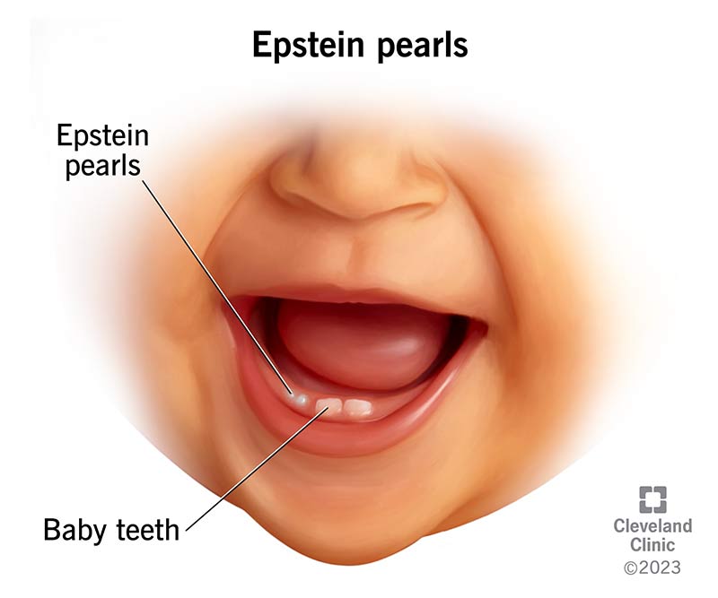<p>Epstein Pearls</p>