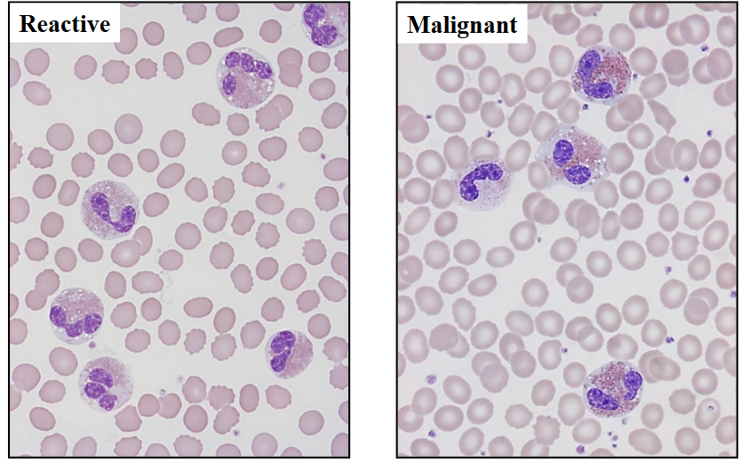 <p>Eosinophillia</p>