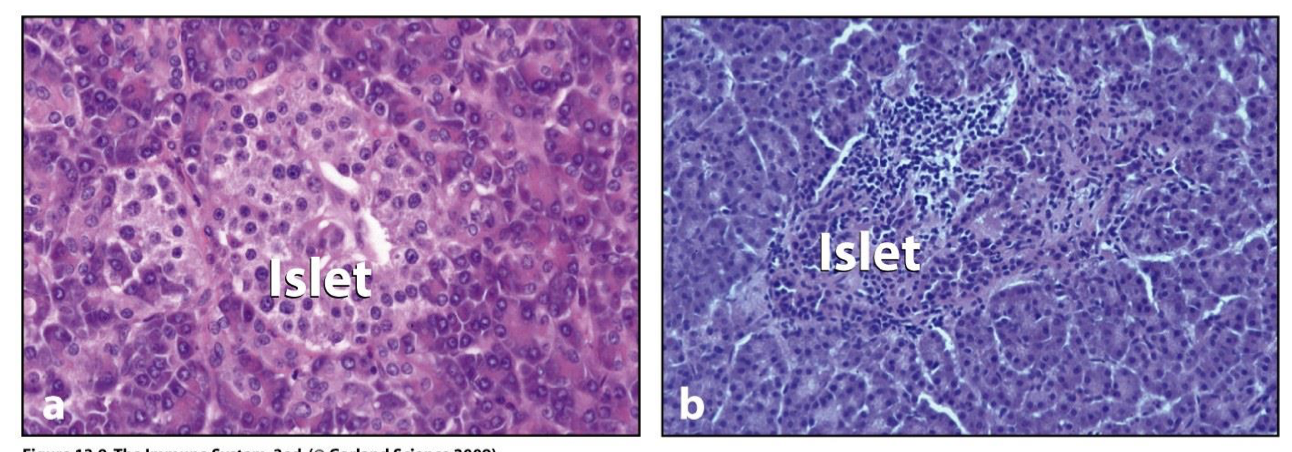 <p>islets infiltrated with lymphocytes</p>