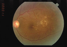 <p>lipid residues of serous leakage from damaged capillaries<br>creamy/yellowish, lesions w/ well-defined borders. Small, round</p>