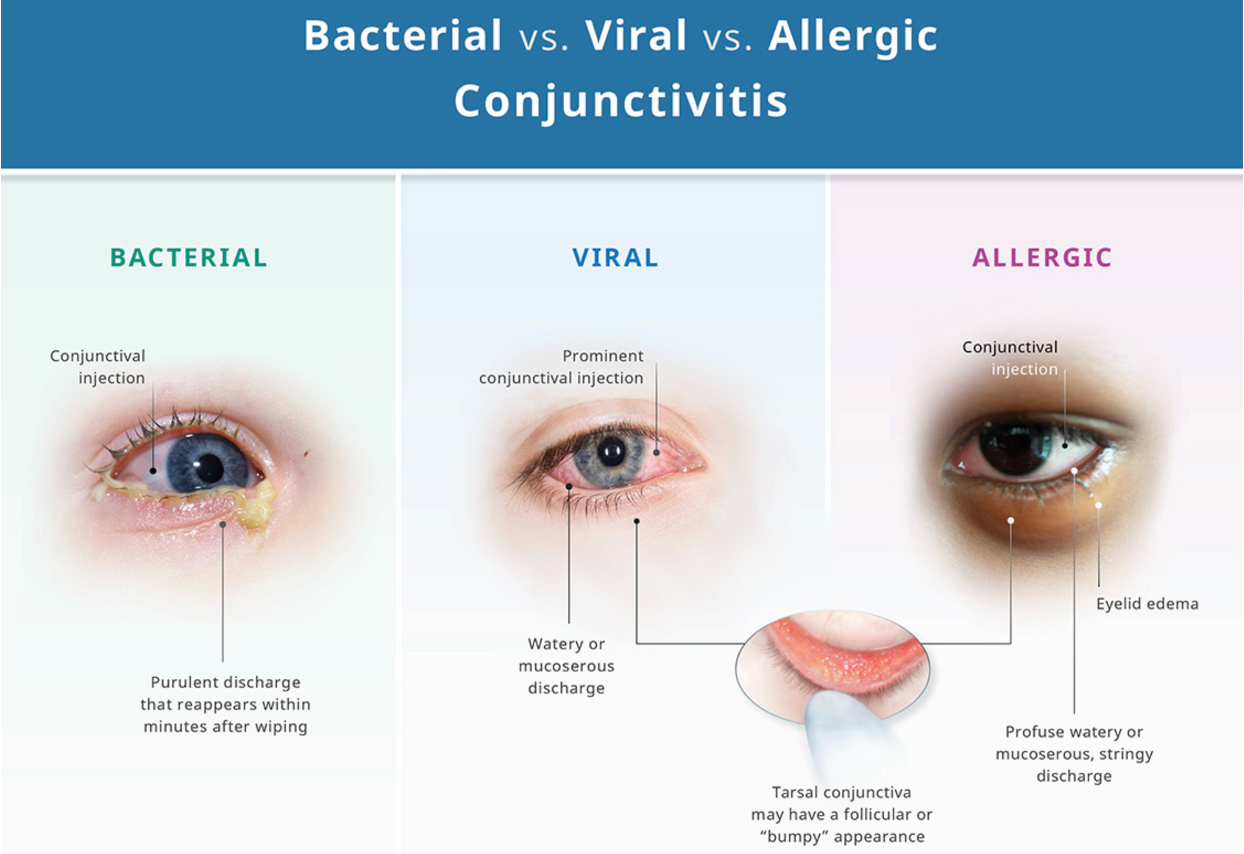 <ul><li><p><span>Also known as Hay fever</span></p></li><li><p><span>Environmental allergens play a role</span></p></li><li><p><span>Results from the allergen causing an inflammatory response when it contacts the ocular surface</span></p></li><li><p><span>Vernal conjunctivitis and atopic conjunctivitis are considered to be more severe and chronic forms of allergic conjunctivitis. They are due to mast cell and lymphocyte-mediated immune processes</span></p></li></ul><p></p>
