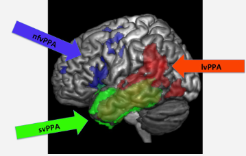<p>Logogenic Variant (lvPPA)</p>