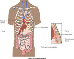 <p>Define Peritoneovenous shunting (PVS)</p>