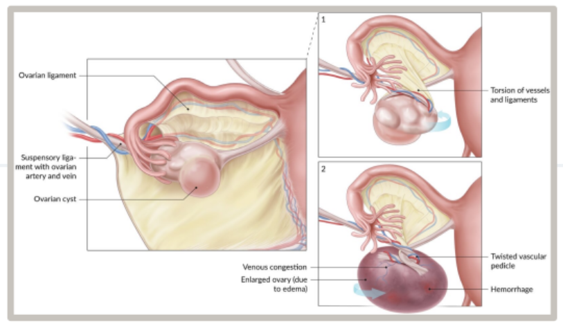 <p>Twisting of an ovary around the adnexal ligaments: partial or complete twisting of the ovary and fallopian tube around their supporting ligaments</p><p>Torsion → venous congestion/edema → ovarian blood supply cut off</p><p><strong>RF</strong>: women of child-bearing age, ovarian enlargement (cysts/dermoid cysts, tumours etc → weight on ovaries), pelvic ligament laxity, Hx PID, previous pelvic surgery</p><p><strong>Sx</strong>: <em>sudden onset unilateral lower abdominal/pelvic pain</em>, palpable adnexal mass/adnexal tenderness</p><ul><li><p>Intermittent/spontaneously resolving pain = partial torsion</p></li></ul><p><strong><u>First Line</u></strong>:</p><ul><li><p><strong>Pelvic US w Doppler (Transvaginal)</strong>: enlarged. edematous ovary with decreased blood flow</p></li><li><p><strong>Bloods</strong>: G+H/Coagulation Panel/CBC (emergency preoperative tests)</p></li></ul><p><strong><u>Other</u></strong>: MRI/CT Abdo/Pelvis w Contrast (if US inconclusive)</p>