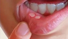 <p>nhiệt miệng</p>