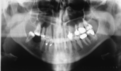 <p>ID the positional error from the radiograph:</p>