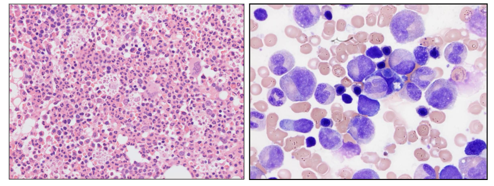 <p>Bone Marrow Response</p>