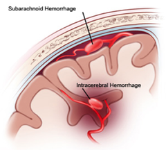 <p>-most common type of hemorrhagic stroke</p><p>-Rupture of small vessels inside the brain, most deadly type of stroke (bleeding of the brain tissue)</p>