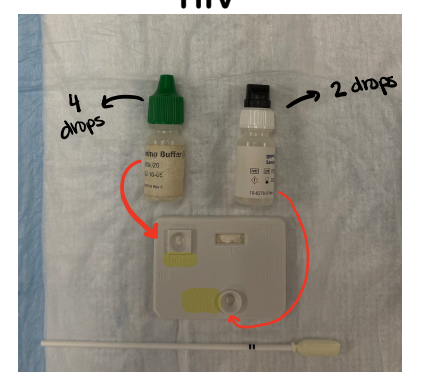 <p>HIV Testing</p><ul><li><p></p><p><strong>Collection</strong>: Gently swab the test stick along the upper and lower gums four times for at least 30 seconds.</p><p></p></li><li><p><strong>Processing</strong>:</p><ul><li><p>Insert the stick into the SampleTrainer bottle and snap the shaft at the notch.</p><p></p></li><li><p>Replace the cap and shake for at least 10 seconds.</p><p></p></li><li><p>Invert the bottle vertically over the sample/buffer well and add 2 full drops.</p><p></p></li><li><p>Wait 5 minutes, then add 4 drops of green-cap Running Buffer vertically into the buffer well.</p><p></p></li></ul></li><li><p></p><p><strong>Reading</strong>: Read between 25–40 minutes.</p><p></p><ul><li><p>One line is negative; two lines are positive.</p><p></p></li><li><p>If nonreactive, you must wait the full 40 minutes before reporting a negative.</p></li></ul></li></ul><p></p>