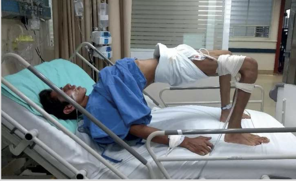 <p>neck bridging- back arched with only occiput touching the bed</p><p></p><p>PCP OD, meningitis, severe tetanus, strychnine poisoning</p>