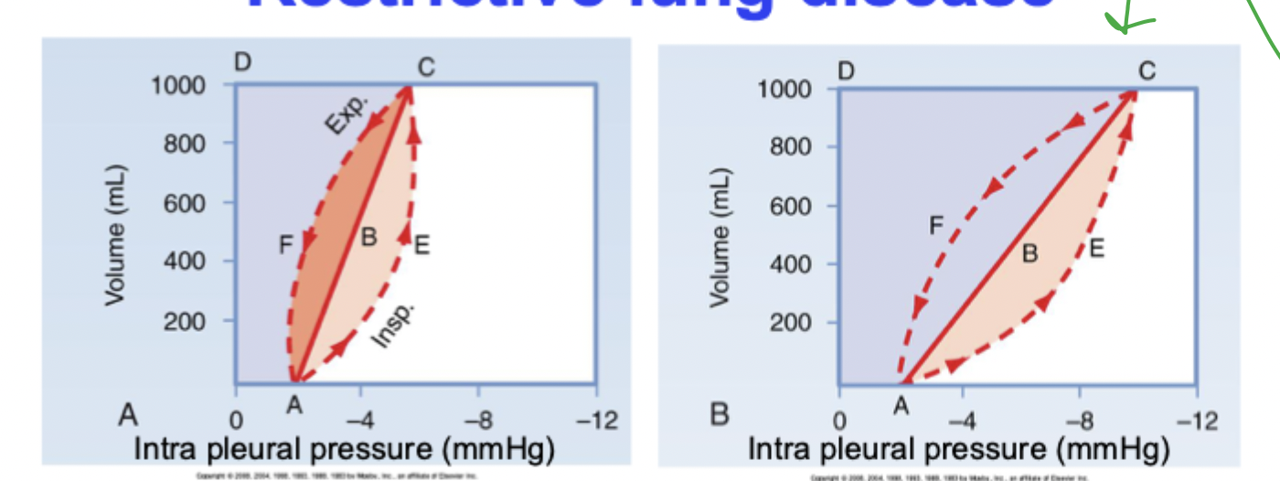 <p>e.g. when a lung becomes fibrotic (pulmonary fibrosis or fibrotic lung disease)</p><p>the whole pressure volume loop shifts RIGHT</p>