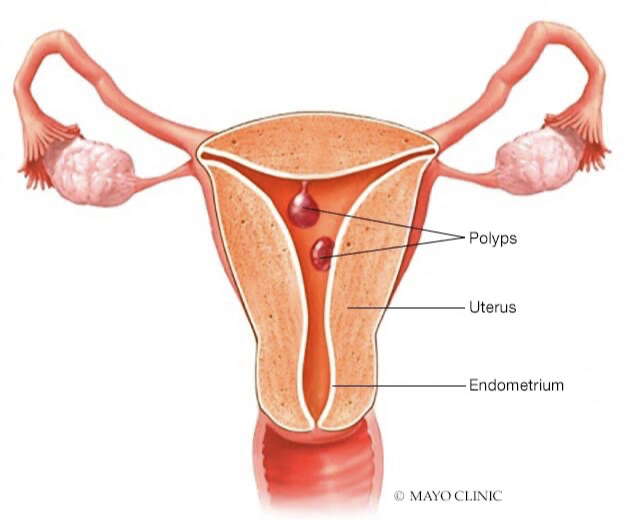 <ul><li><p>See inter-menstrual bleeding </p></li><li><p>Can often not be seen on exam: need pelvic exam or hysterectomy </p><ul><li><p>Can use sonohysterography: separates endometrium to better see structural issues (may be difficult to see on U/S) </p></li><li><p>Endometrial biopsy may return fragments of polyp </p></li></ul></li><li><p>Needs to be removed </p></li></ul><p></p>