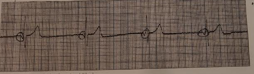 <p>howd you know that it was a junctional escape rhythm</p>
