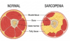 <p>sarcopenia </p>