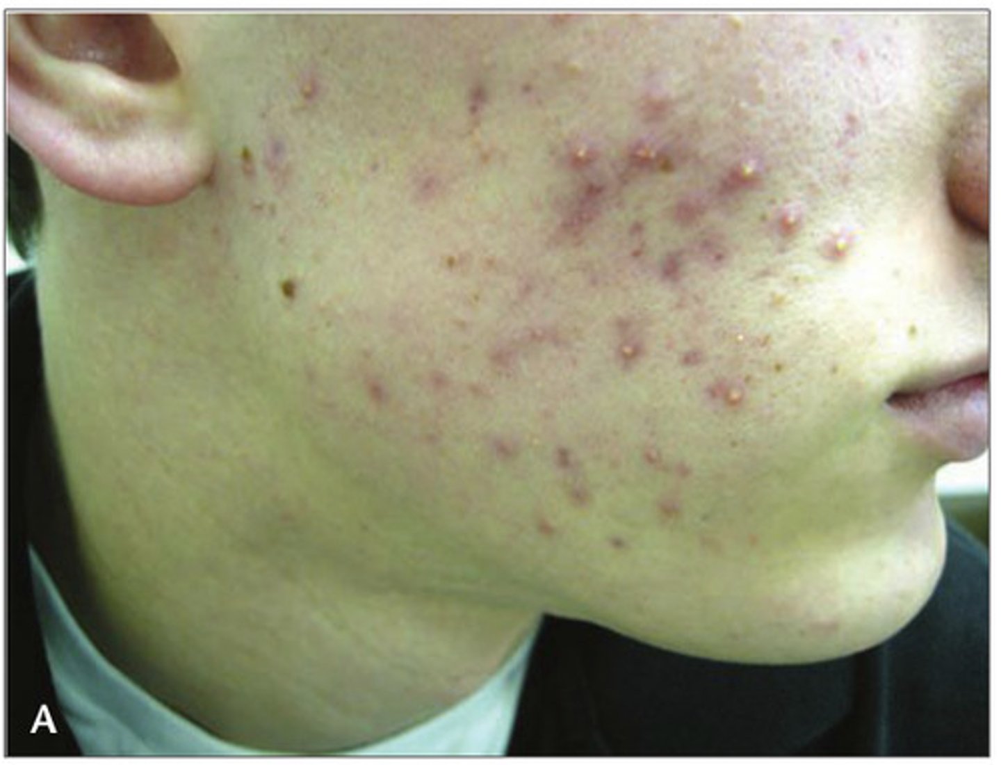 <p>mụn Many teenagers suffer from ___________ due to hormonal changes.</p>