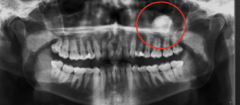 <p>What is the location of this lesion?</p>