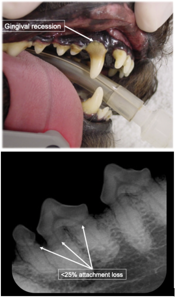 <p>What is the stage of periodontal disease shown in this image?</p>