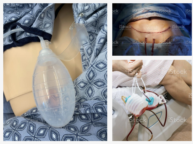 <p>Drain</p><p>Purpose: drains pus, blood, or other fluid postoperatively to prevent it from accumulating in the body (<span style="background-color: transparent;">Drains can be active (driven by negative pressure) or passive (simply channels fluids)</span></p>