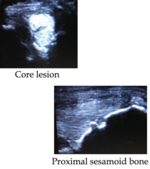 <p>What is suspensory ligament branch desmitis caused by?</p>