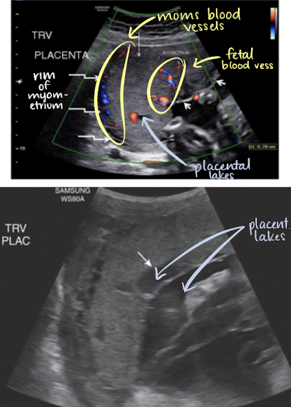 <ul><li><p><span style="color: yellow;">homogeneous</span></p></li><li><p>pebble-gray—mildly <span style="color: yellow;">more echogenic</span> compared to uterine wall</p><ul><li><p>may be more echogenic in 1st trimester</p></li></ul></li><li><p>smooth borders</p></li><li><p>highly <span style="color: yellow;">vascular</span> structure</p></li><li><p>rim of myometrium outside placenta should be noted</p></li><li><p>prominent maternal vessels may be seen posterior to placenta (anechoic tubes)</p></li><li><p><span style="color: yellow;">placental lakes</span> may also be seen in placenta</p></li></ul><p></p>
