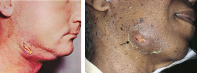 <ul><li><p>bacteria catalase (-) anaerobes </p></li><li><p>gram (+), sulfur granules, filamentous</p><ul><li><p>via poor oral hygiene or trauma/surgery</p></li></ul></li><li><p>usually cervicofacial → lumpy jaw</p></li></ul><p></p>