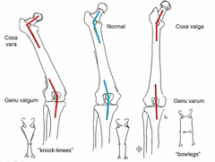 <p>Angle between neck & shaft of femur > 135°</p>