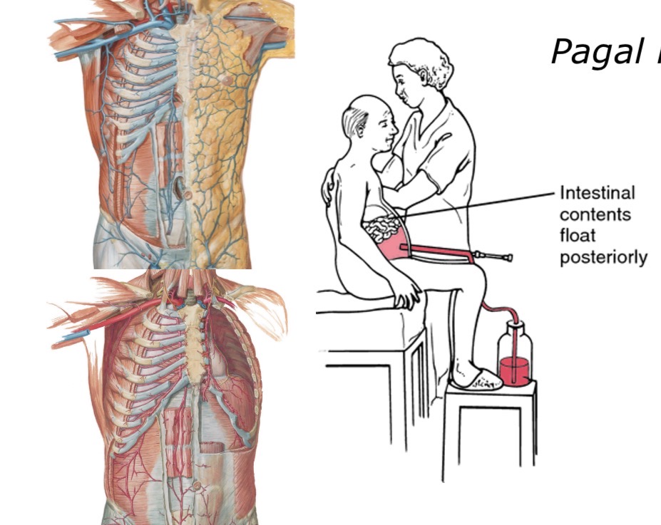 <p>Kodėl paracentezės vieta ties linea mediana žemiau bambos yra saugi?</p>
