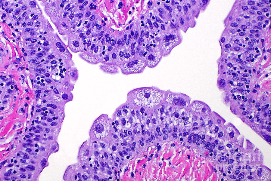 <p>Many shapes, appear stratified (pseudostratified), might see multinucleated cells (umbrella cells) at surface; only in ureter, bladder, and urethra (look for lumen)</p>
