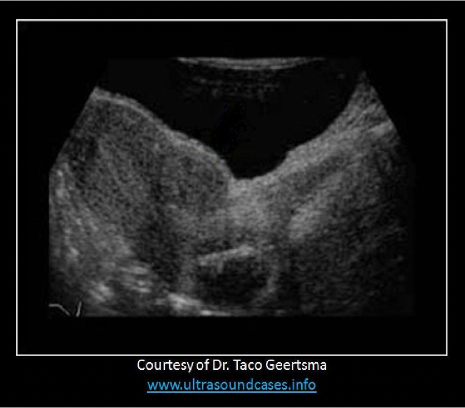 <p>A patient presents with irregular bleeding and pelvic pain for the last two months. Which of the following statements best describes the image displayed?</p><p>A. There is a submucosal fibroid present.</p><p class="p1">B. There are multiple fibroids present in the body of the uterus and cervix.</p><p class="p1">C. There is a subserosal fibroid present with an IUD in the uterine cervix</p><p class="p1">D. There is a tampon present in the cervix</p>