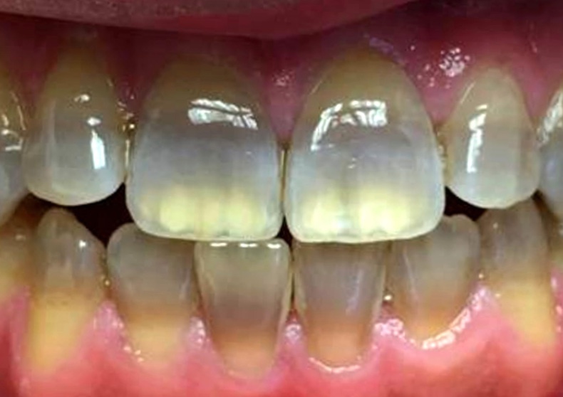 <p>tetracyline teeth</p>