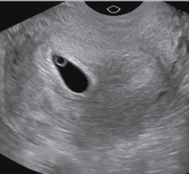 <p>Small round cystic anechoic structure; within gestational sac; bright thin echogenic walls; normally measures less than 6mm; image shows normal size and if larger, tend to not make it</p>
